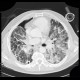 Lung fibrosis, decompensation after lobectomy: CT - Computed tomography